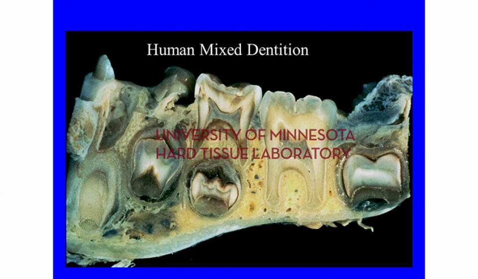 Human Mixed Dentition